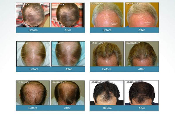 Laser hair growth helmet